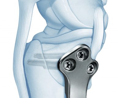 Print Advetis medical TPLO